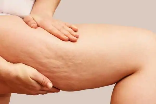 Image of woman showing leg with cellulite Stanmore