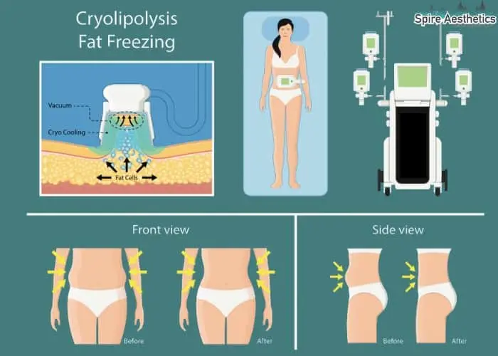 Fat freezing treatment Stanmore benefits for competitions to remove stubborn fat deposits.