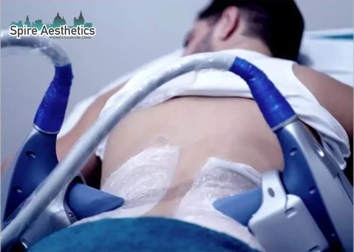 Man having fat freezing treatment done on love handles before a competitions Stanmore to create a sculpted look.