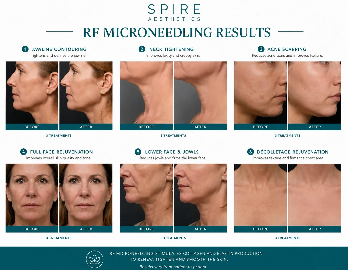 RF Microneedling Skin tightening Stanmore results