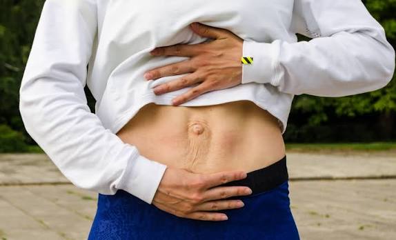 When Could Diastasis Recti Be the Missing Piece of the Puzzle Stanmore?