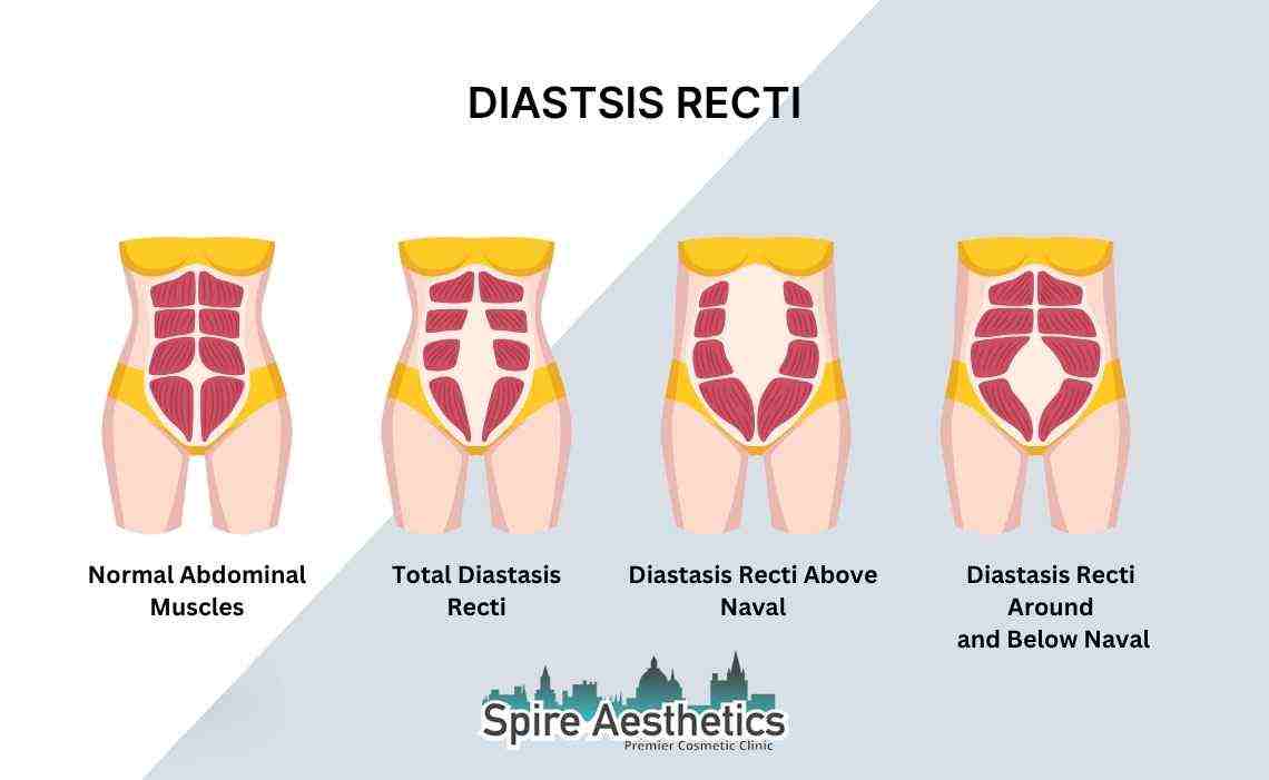 Is Non-Surgical Diastasis Recti Treatment Right for You? Common Concerns Answered Stanmore